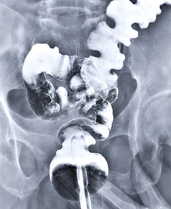 结直肠摄影照片_钡剂灌肠示l直肠和结肠，用于诊断结直肠癌或结肠癌。