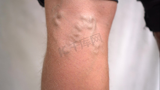 可以摄影照片_在腿部男性特写镜头的皮肤下可以看到静脉曲张。