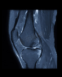 膝关节 MRI 或膝关节磁共振成像搅拌技术的轴向、矢状和冠状视图对脂肪抑制的比较。