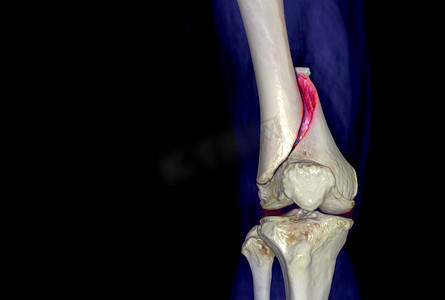 CT 膝盖 3D 渲染图像 AP 视图隔离在黑色背景上，显示股骨骨折。