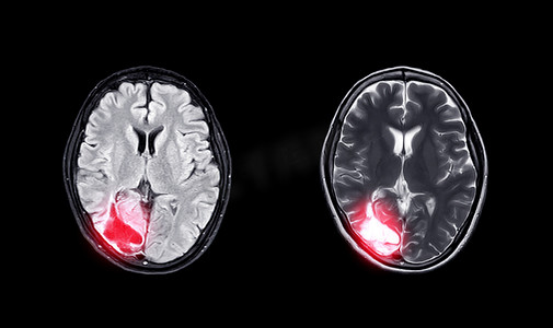 动脉瘤摄影照片_比较 MRI 脑轴 T2W 视图和 T2W 视图以显示脑软化症。
