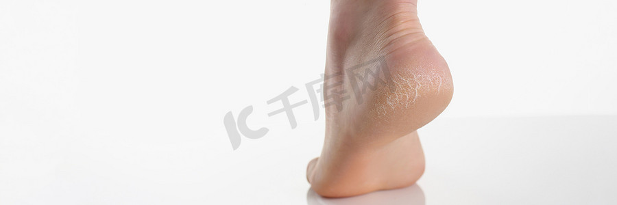 干裂的摄影照片_单女性腿或脚跟显示干裂的脚跟和干燥的皮肤