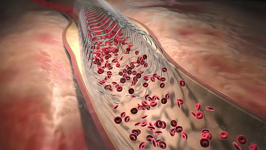 动脉搏动与血压摄影照片_血红蛋白细胞流过阻塞的动脉，导致动脉硬化疾病。
