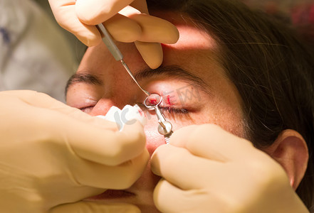 医疗保健概念 — 眼科检查和手术期间的霰粒肿