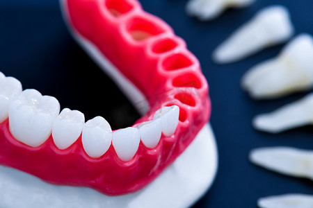 种植牙和牙冠安装过程