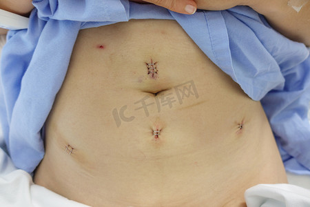 子宫肌瘤摄影照片_腹腔镜子宫肌瘤切除术后女性子宫肌瘤病例