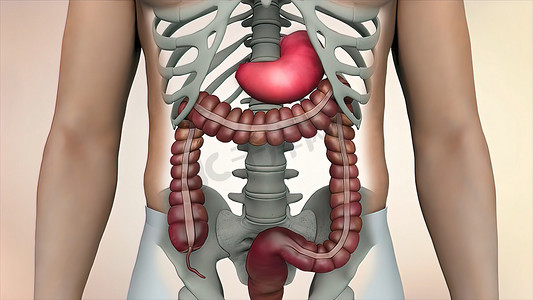 肠镜检查期间的结肠，可见肠或肠癌肿瘤。