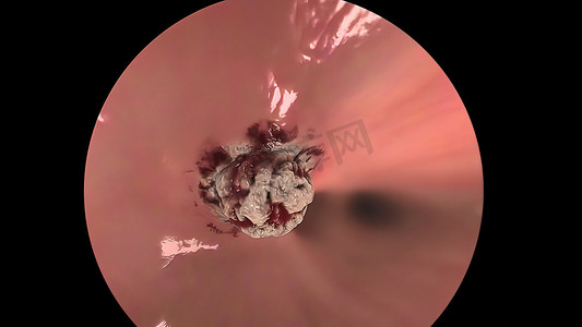 荧光摄影照片_通过使用支气管镜和荧光成像确认肺部状况来切除肿瘤