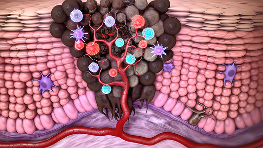 皮肤3d摄影照片_皮肤癌的 3d 医学插图：鳞状细胞癌、基底细胞癌