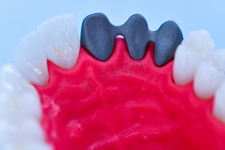 种植牙和牙冠安装过程