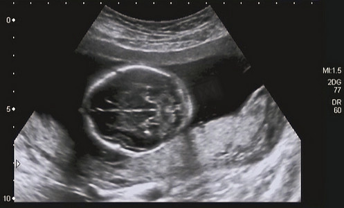 四象限法摄影照片_第四个月胎儿的超声检查分析