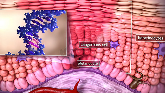 肠道细胞摄影照片_皮肤癌的 3d 医学插图：鳞状细胞癌、基底细胞癌