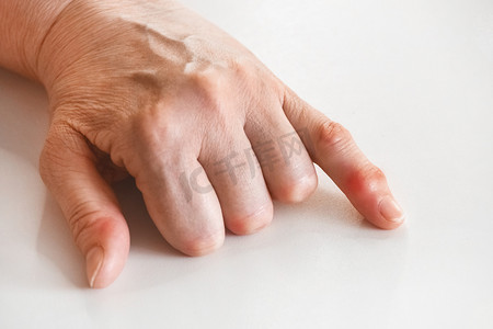 一位患有手部风湿病和关节特写变化的老年妇女的手