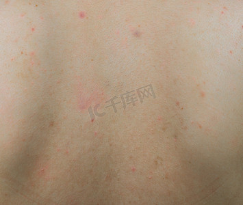 背部痤疮特写，女性背部皮肤上有红色斑点和深棕色斑点。