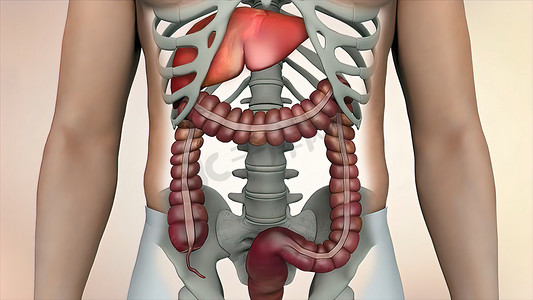 肠镜检查期间的结肠，可见肠或肠癌肿瘤。