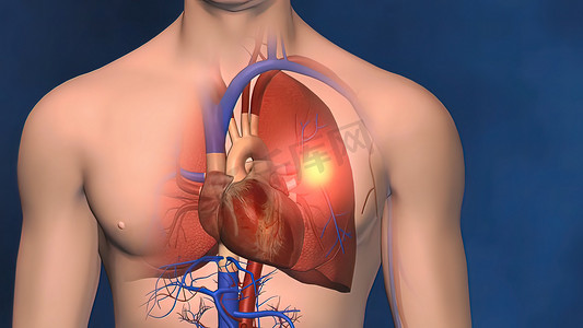 血栓摄影照片_血栓可能会危及生命，具体取决于它们的位置和严重程度。