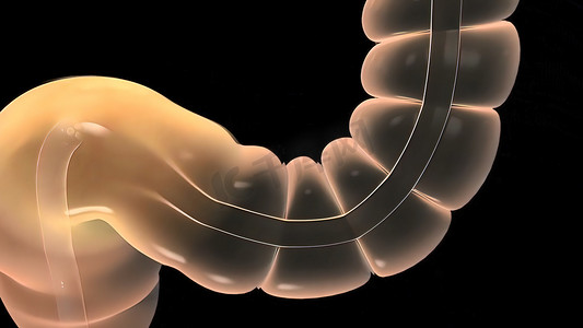 结肠镜检查是使用称为结肠镜的管子对大肠进行可视化。