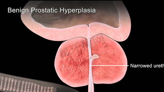 良性前列腺增生 3d 医疗