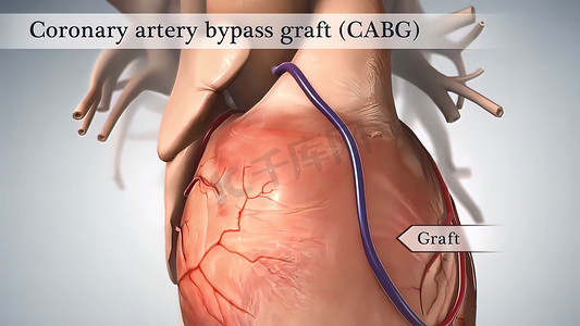 冠状动脉搭桥手术是使用称为移植物的健康血管进行的。