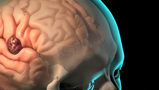 脑肿瘤是大脑中异常细胞的集合或团块。