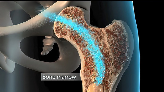 人骨质疏松症海绵组织从正常到病态的发育
