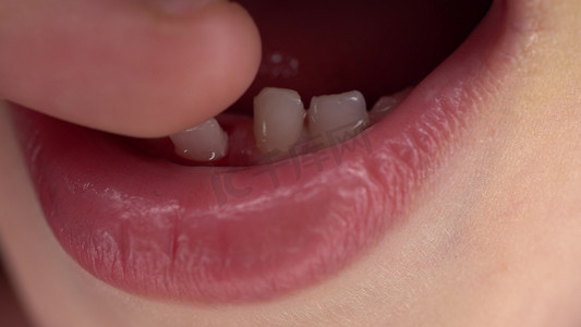 一个小孩有一颗松动的乳牙。