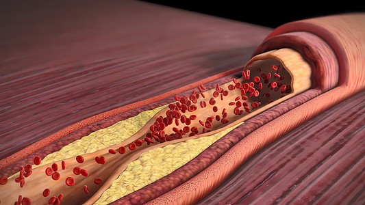 颈动脉硬化示意图摄影照片_胆固醇斑块、动脉粥样硬化和心脏病发作