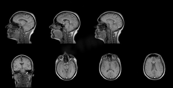矢摄影照片_一组 60 岁白人女性头部矢状面和水平面的连续 MRI 扫描