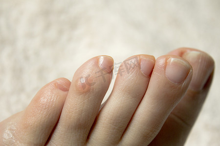 脚趾甲有真菌