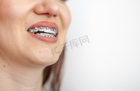 一个年轻女孩的笑容，洁白的牙齿上戴着牙套。