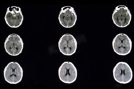 脑卒中摄影照片_脑动脉瘤破裂的 CT 脑部扫描
