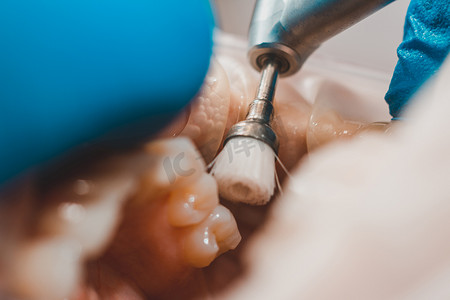 牙医用钻头抛光牙齿，这是一种牙科手术。