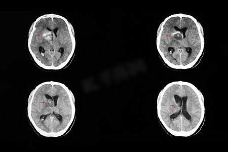 转移性癌症的脑部CT