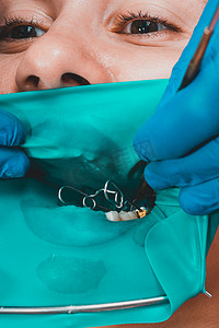 一位病人在看牙医时，医生使用橡皮障治疗牙齿，消毒牙齿以进行补牙。