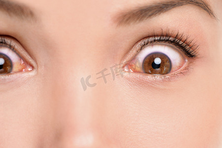 红眼妇女患有过敏反应结膜炎刺激充血的眼睛炎症。