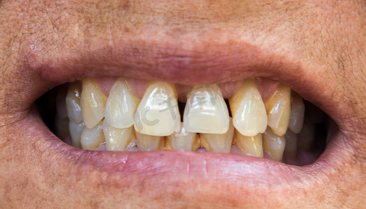 特写老妇牙齿问题与牙龈或牙垢健康