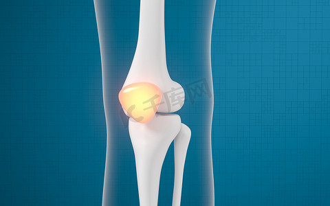 腿骨和膝盖病变，3D 渲染。