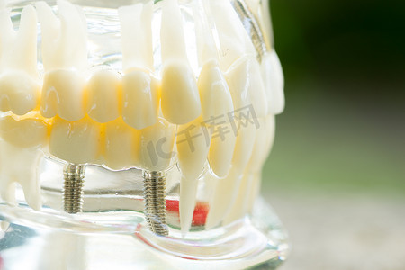 一套牙医的设备工具、显示植入物的假牙