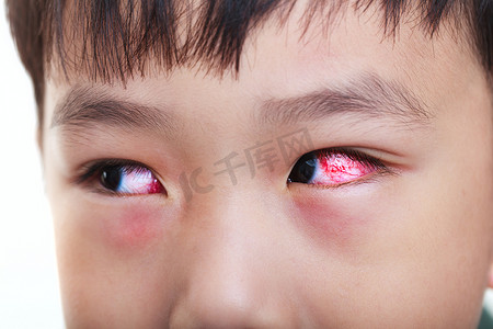 慢性结膜炎与红色虹膜的特写。