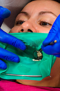 牙医用橡皮障、钻头、镜子治疗病人的牙齿。