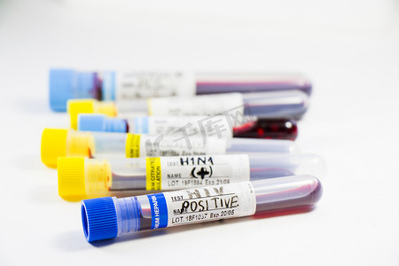 HIV和艾滋病感染血液检测样本、诊断和实验室化学液体元素