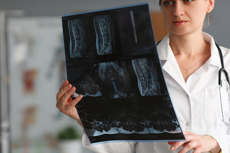 腰椎手术摄影照片_年轻女医生拿着人脊柱的 X 光片