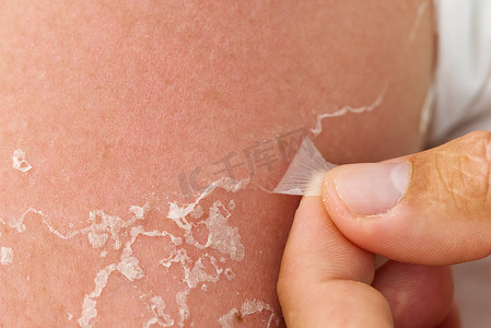 人类的皮肤摄影照片_皮肤被阳光灼伤后脱皮。
