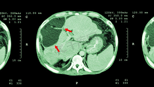 肝细胞摄影照片_上腹部CT扫描：显示肝脏异常肿块（肝癌）