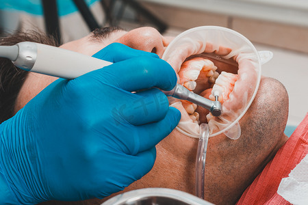 病人去除牙垢，牙医使用超声波去除牙垢，洁牙机。