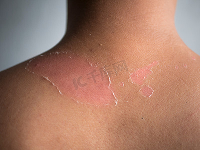 夏季日光浴对年轻人身体的晒伤影响，导致背部和肩部皮肤脱皮。