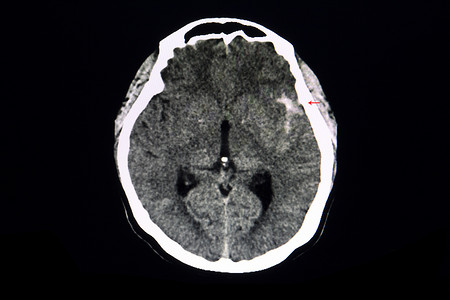 脑卒中摄影照片_CT脑动脉瘤破裂