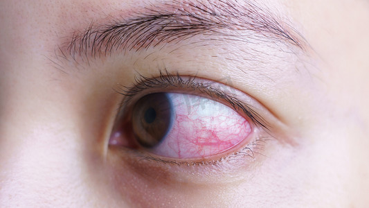 妇女充血的红眼，被激怒或感染，结膜炎