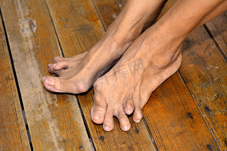 杨字的字体杨变形摄影照片_老妇人的脚因类风湿性关节炎而变形