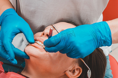 补牙后，牙医用复印描图纸去除牙齿上多余的材料。